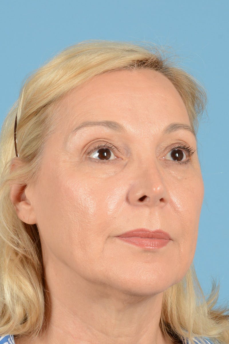 Facelift Before & After Gallery - Patient 144554632 - Image 3