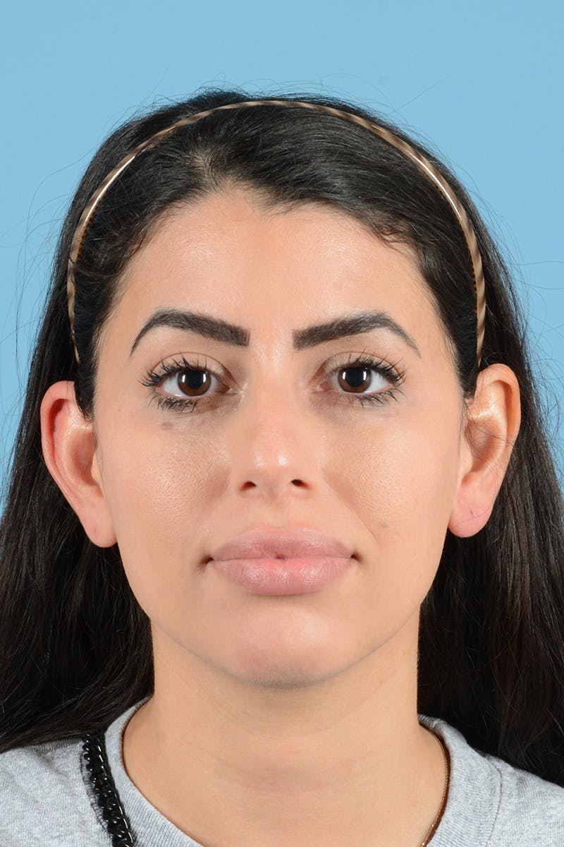 Rhinoplasty Before & After Gallery - Patient 144554637 - Image 1