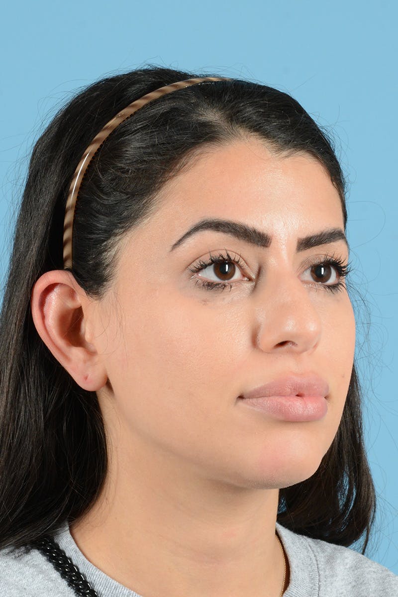 Rhinoplasty Before & After Gallery - Patient 144554637 - Image 3
