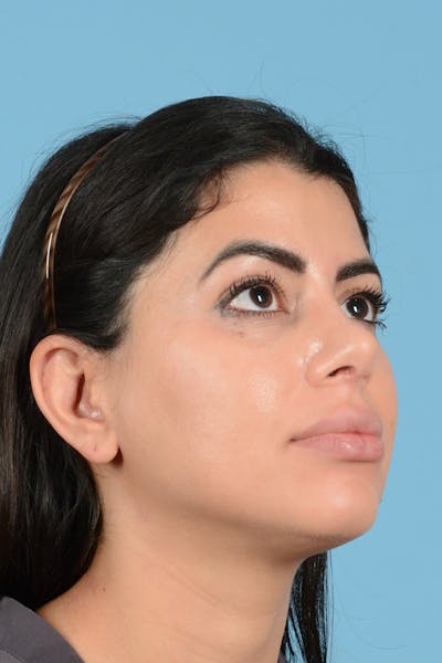 Rhinoplasty Before & After Gallery - Patient 144554637 - Image 4