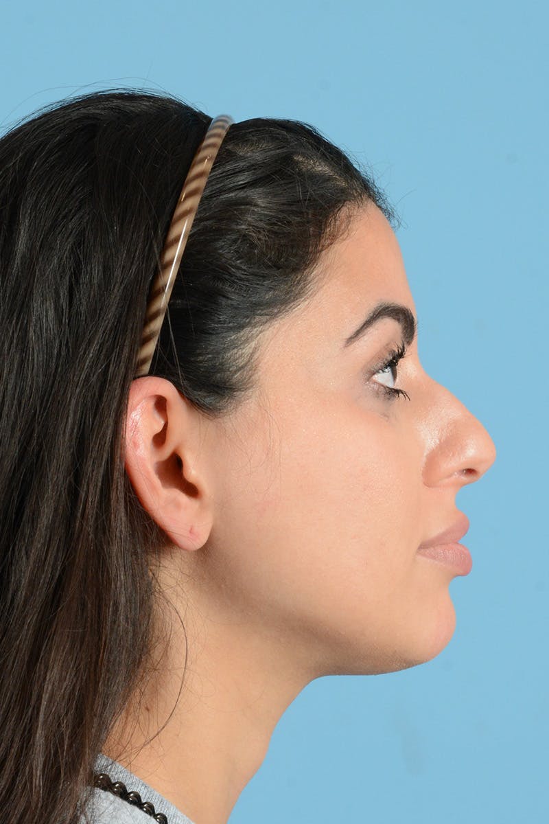 Rhinoplasty Before & After Gallery - Patient 144554637 - Image 5