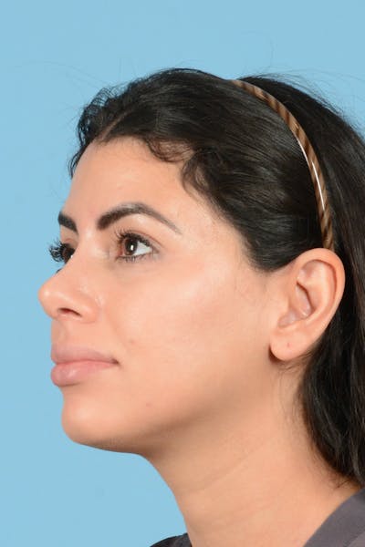 Rhinoplasty Before & After Gallery - Patient 144554637 - Image 8