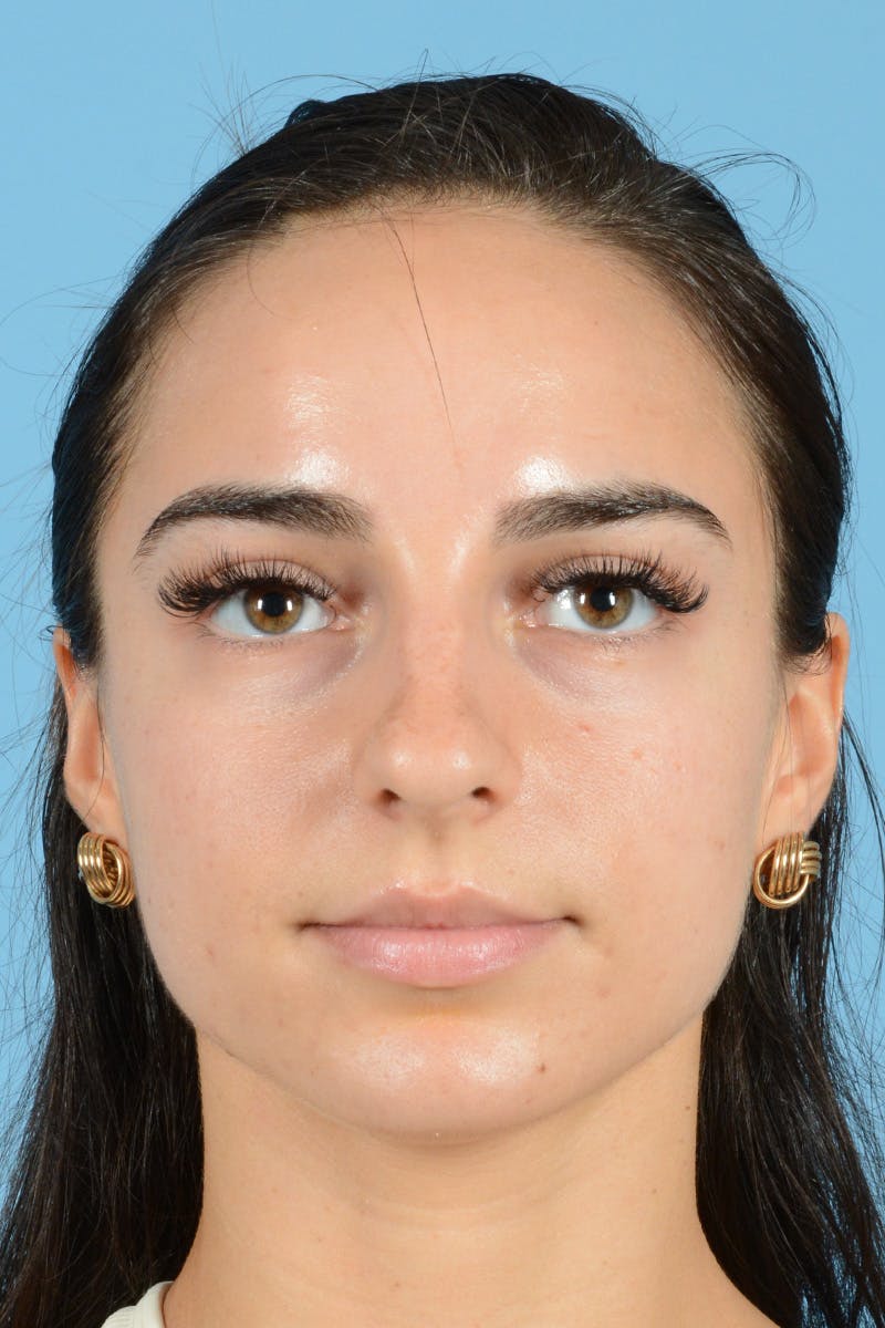 Rhinoplasty Before & After Gallery - Patient 144554641 - Image 1