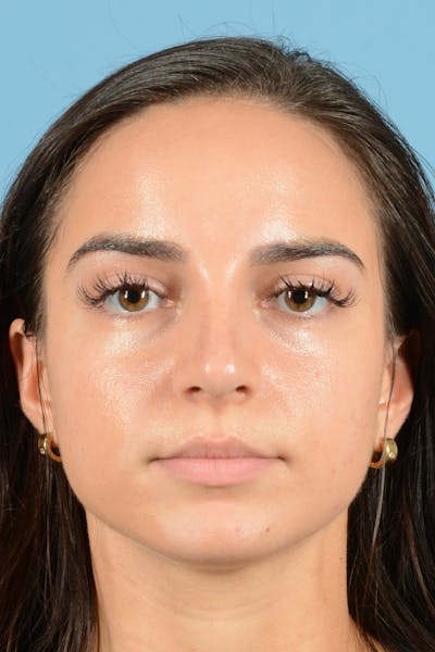 Rhinoplasty Before & After Gallery - Patient 144554641 - Image 2