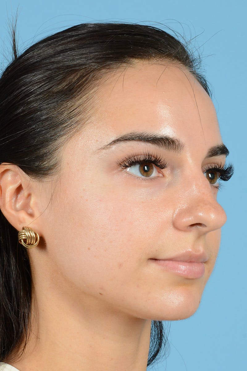 Rhinoplasty Before & After Gallery - Patient 144554641 - Image 5