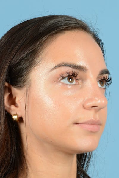 Rhinoplasty Before & After Gallery - Patient 144554641 - Image 6