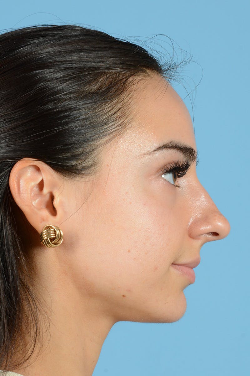 Rhinoplasty Before & After Gallery - Patient 144554641 - Image 7