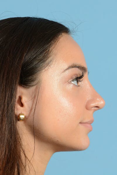 Rhinoplasty Before & After Gallery - Patient 144554641 - Image 8