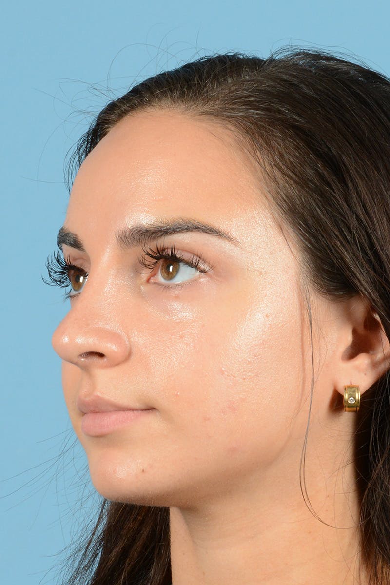Rhinoplasty Before & After Gallery - Patient 144554641 - Image 10