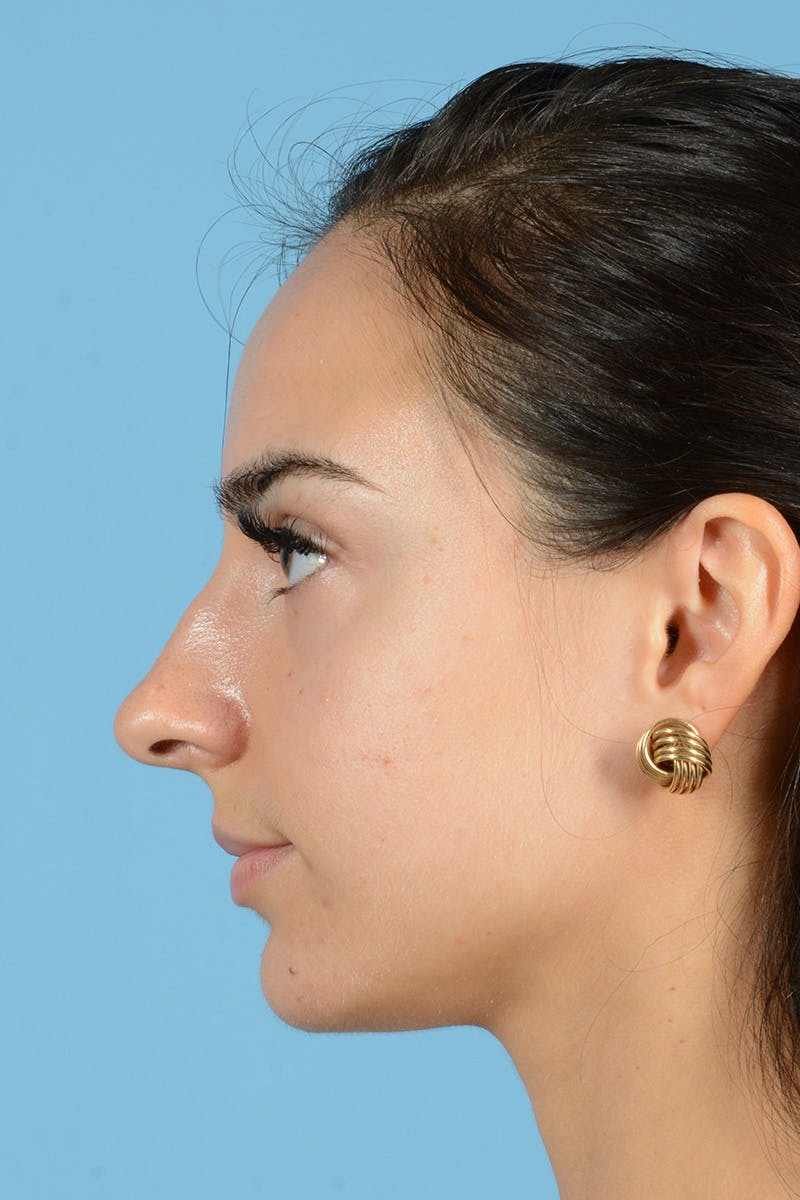 Rhinoplasty Before & After Gallery - Patient 144554641 - Image 11