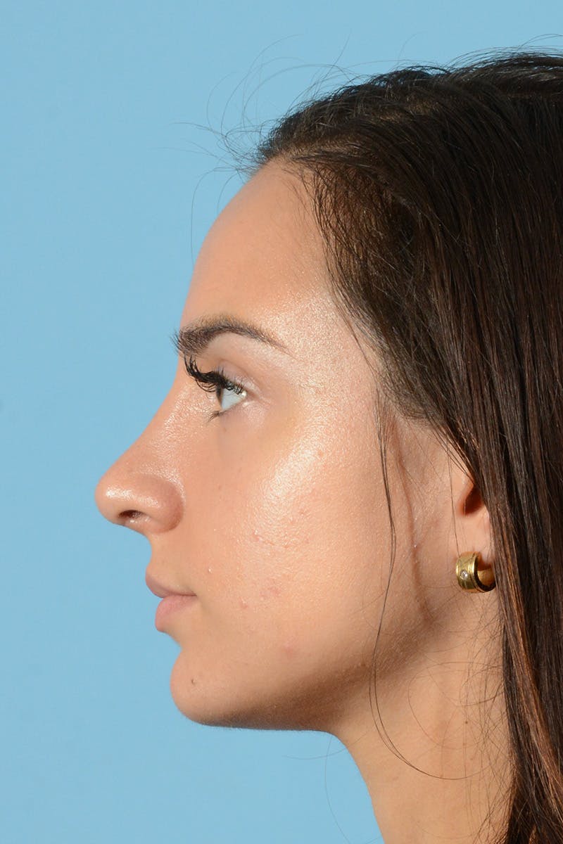 Rhinoplasty Before & After Gallery - Patient 144554641 - Image 12