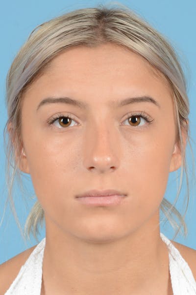 Rhinoplasty Before & After Gallery - Patient 144554650 - Image 1