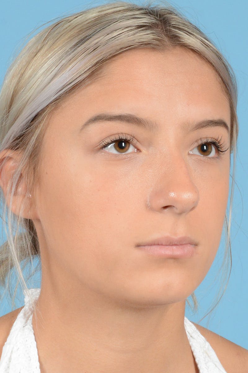 Rhinoplasty Before & After Gallery - Patient 144554650 - Image 3