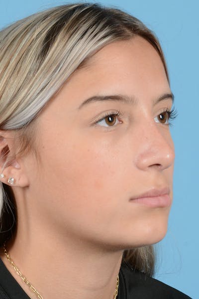 Rhinoplasty Before & After Gallery - Patient 144554650 - Image 4