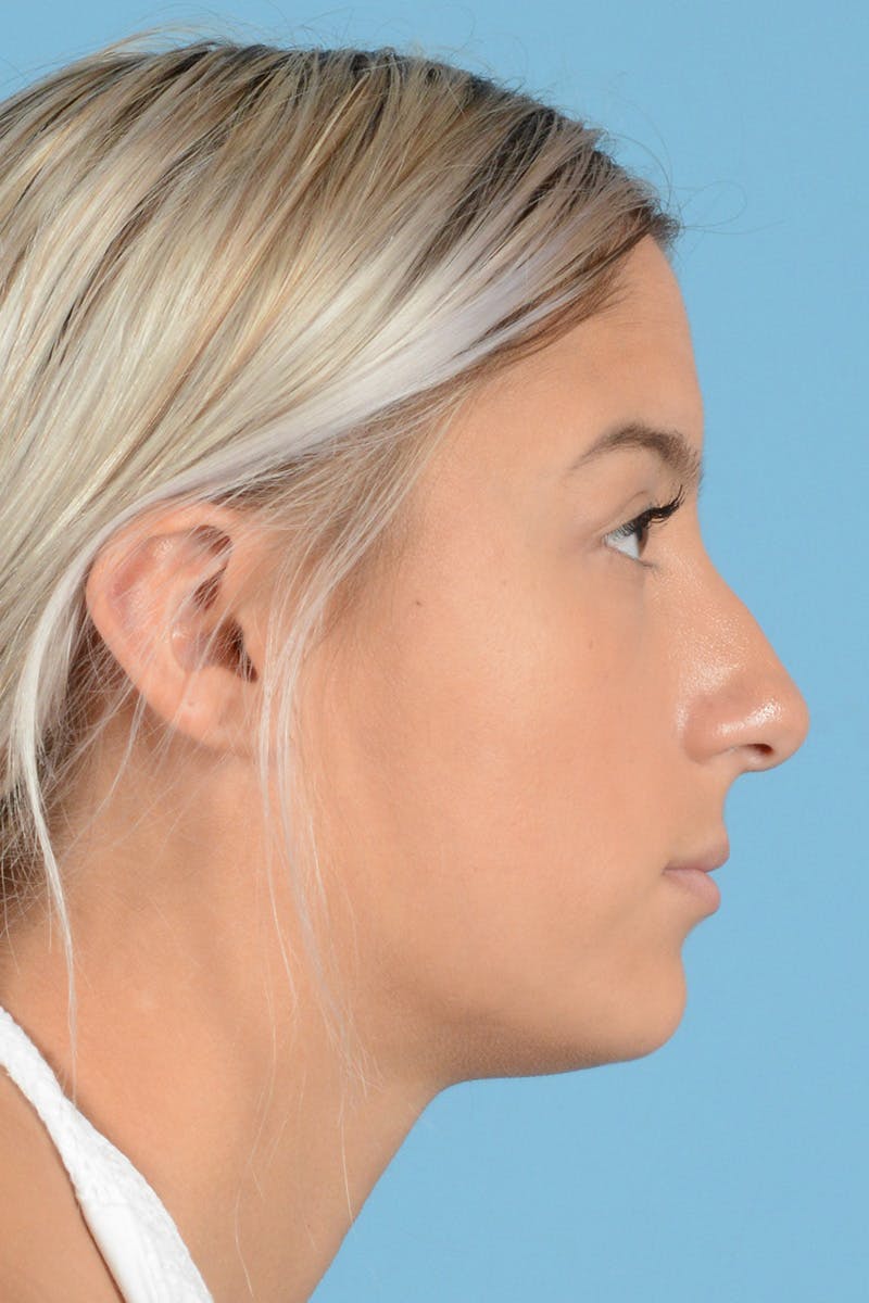 Rhinoplasty Before & After Gallery - Patient 144554650 - Image 5
