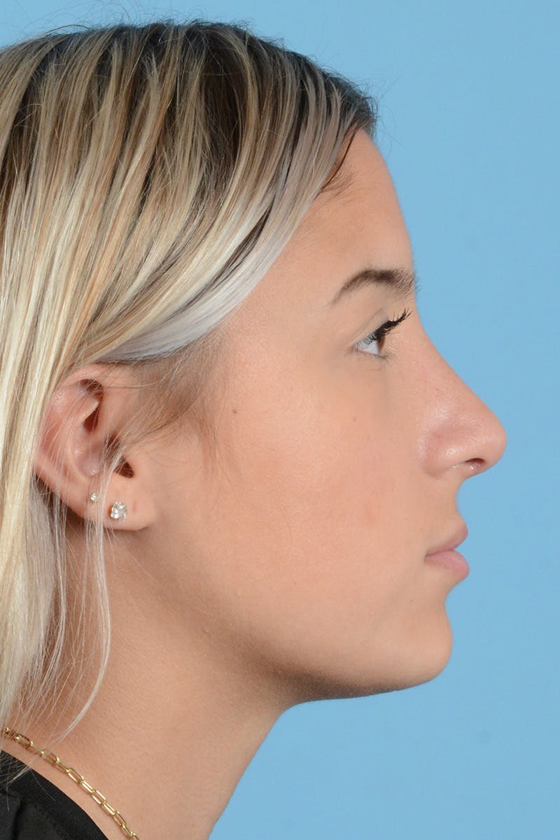 Rhinoplasty Before & After Gallery - Patient 144554650 - Image 6