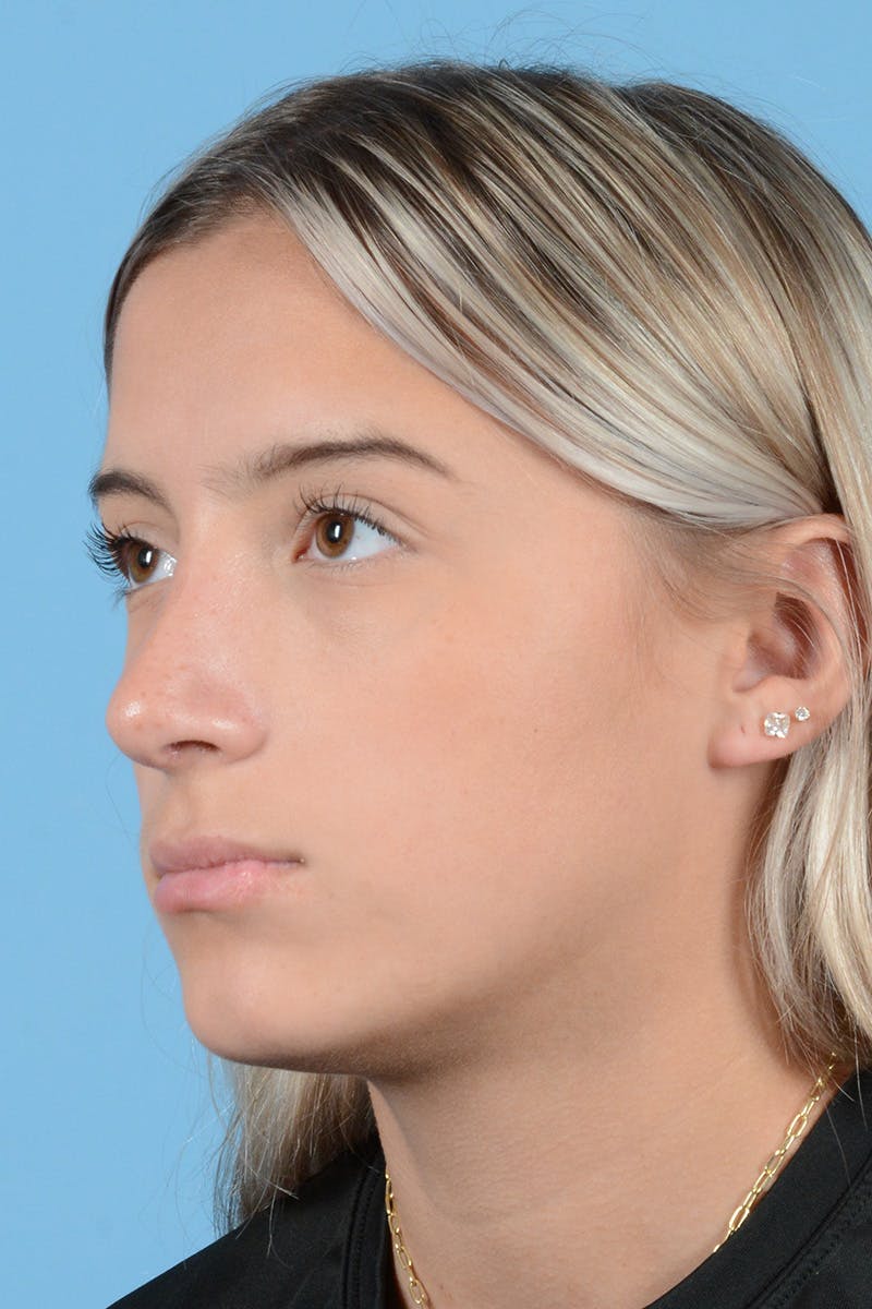 Rhinoplasty Before & After Gallery - Patient 144554650 - Image 8