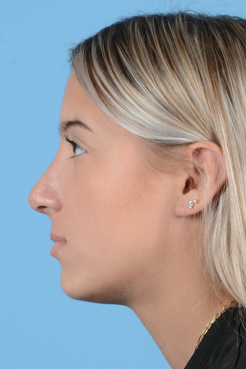 Rhinoplasty Before & After Gallery - Patient 144554650 - Image 10