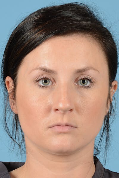 Rhinoplasty Before & After Gallery - Patient 144554649 - Image 1