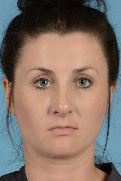 Rhinoplasty Before & After Gallery - Patient 144554649 - Image 2
