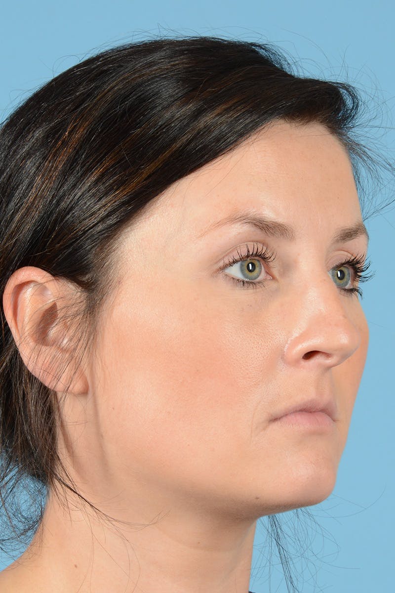 Rhinoplasty Before & After Gallery - Patient 144554649 - Image 3