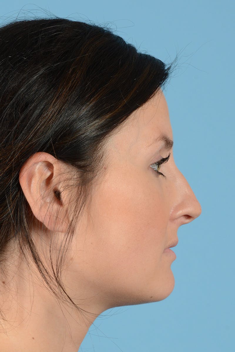 Rhinoplasty Before & After Gallery - Patient 144554649 - Image 9
