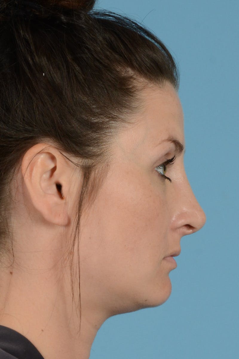 Rhinoplasty Before & After Gallery - Patient 144554649 - Image 10