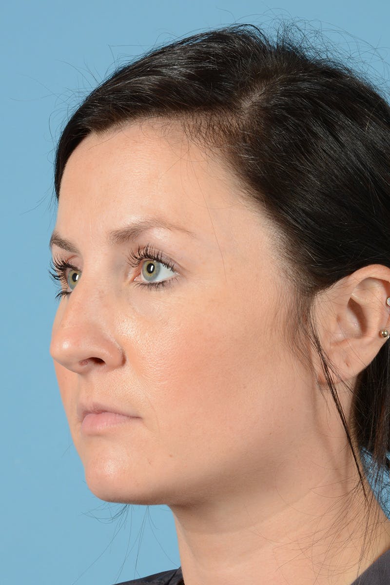 Rhinoplasty Before & After Gallery - Patient 144554649 - Image 5