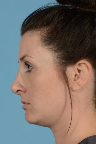 Rhinoplasty Before & After Gallery - Patient 144554649 - Image 8