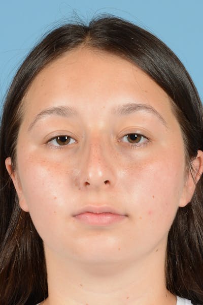 Rhinoplasty Before & After Gallery - Patient 144554651 - Image 1