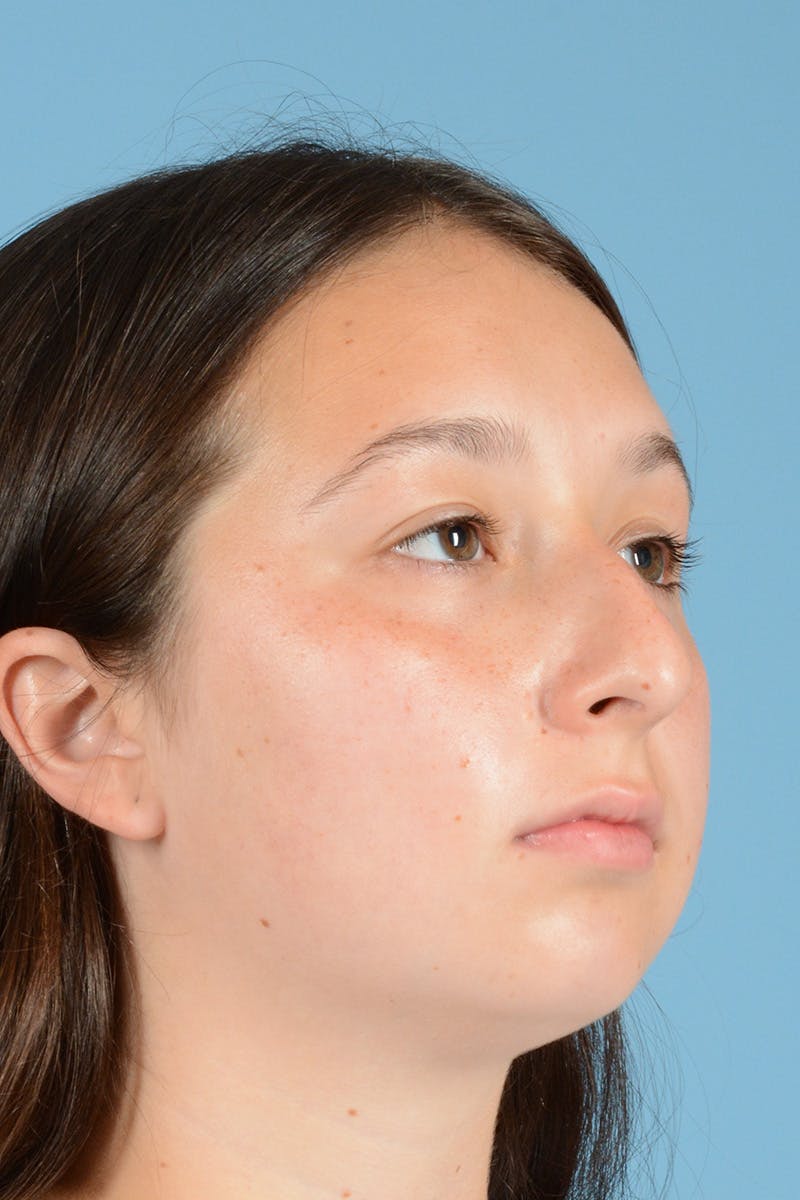 Rhinoplasty Before & After Gallery - Patient 144554651 - Image 3