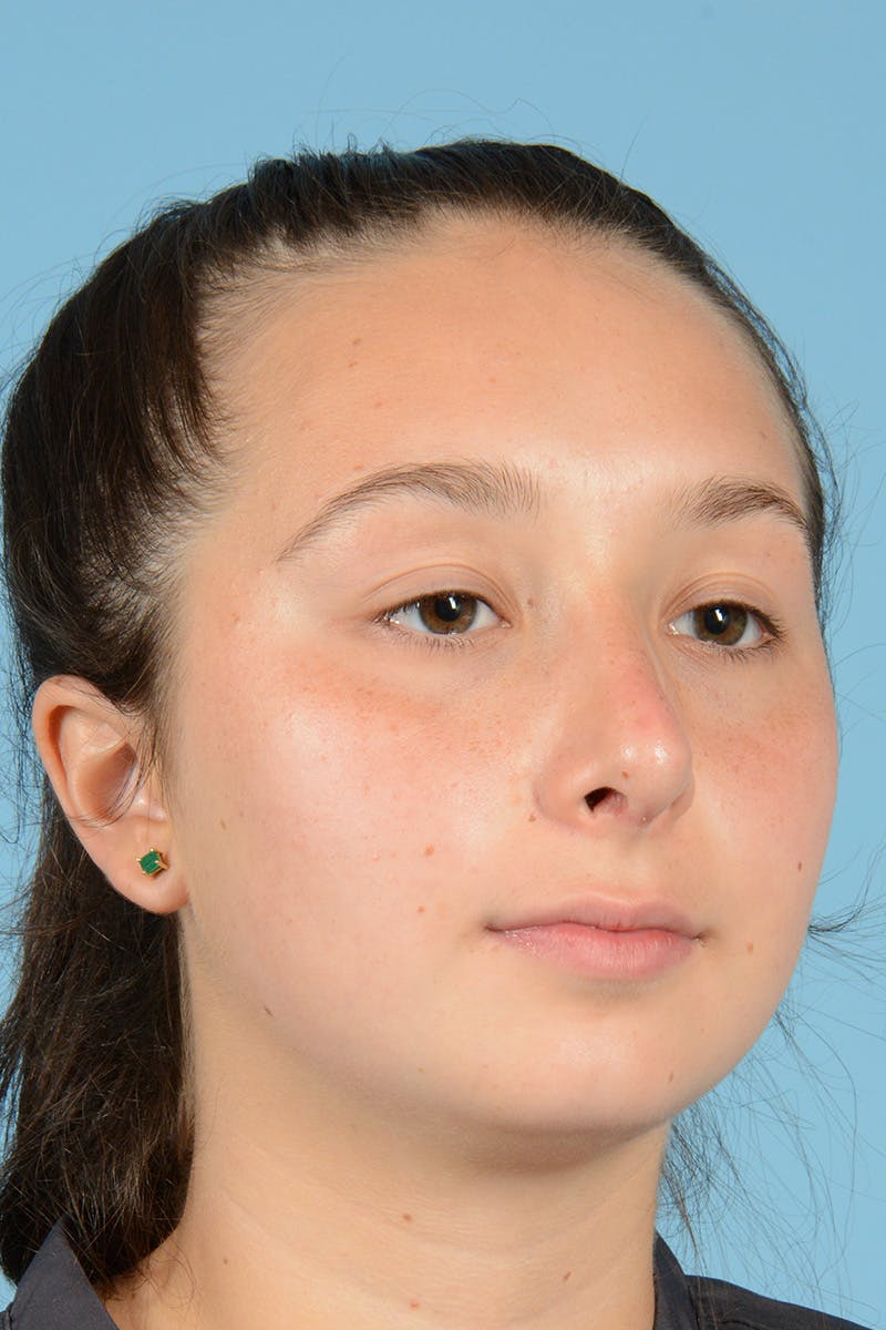Rhinoplasty Before & After Gallery - Patient 144554651 - Image 4