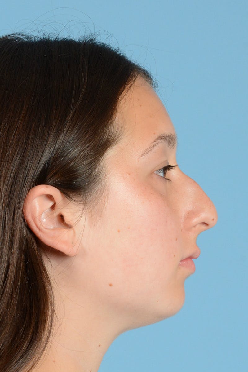 Rhinoplasty Before & After Gallery - Patient 144554651 - Image 5