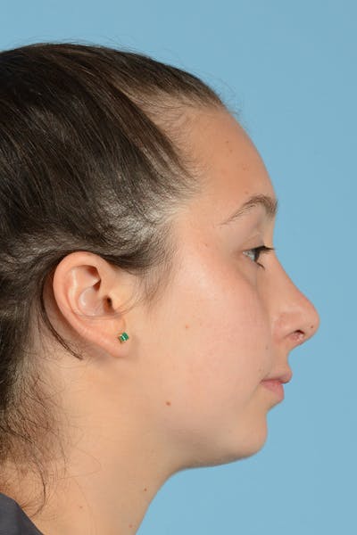 Rhinoplasty Before & After Gallery - Patient 144554651 - Image 6