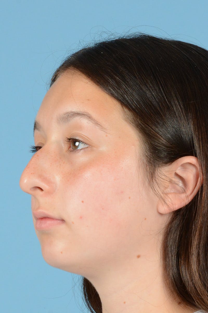 Rhinoplasty Before & After Gallery - Patient 144554651 - Image 7
