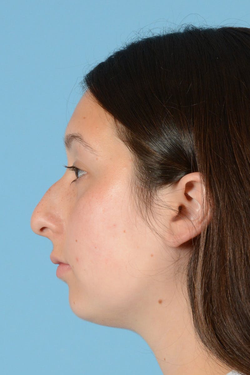 Rhinoplasty Before & After Gallery - Patient 144554651 - Image 9