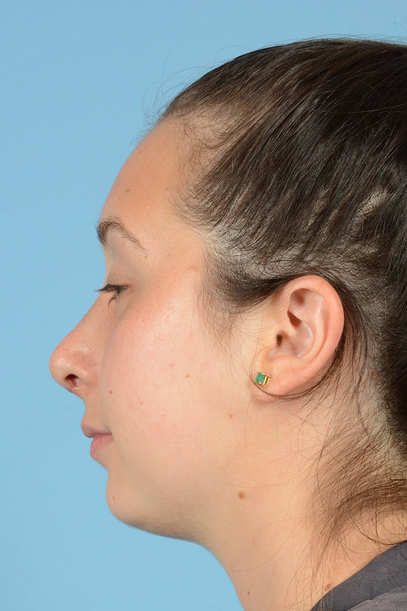 Rhinoplasty Before & After Gallery - Patient 144554651 - Image 10