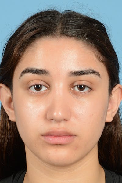 Rhinoplasty Before & After Gallery - Patient 144554654 - Image 2