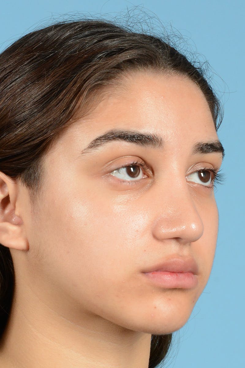 Rhinoplasty Before & After Gallery - Patient 144554654 - Image 4