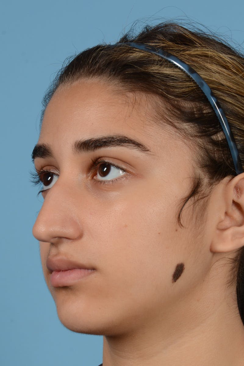 Rhinoplasty Before & After Gallery - Patient 144554654 - Image 7