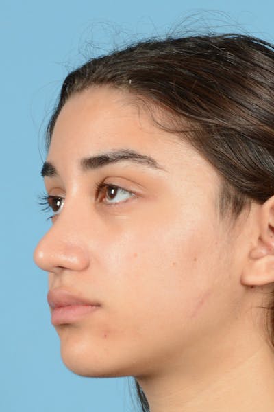 Rhinoplasty Before & After Gallery - Patient 144554654 - Image 8