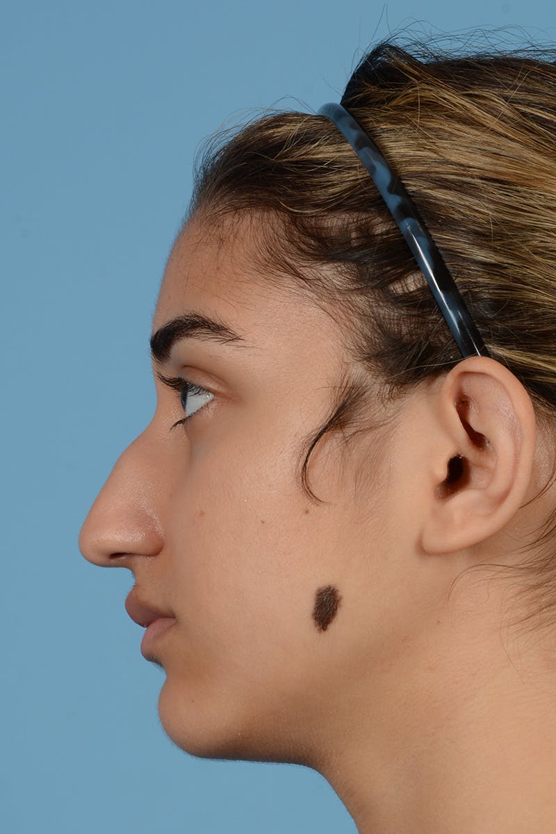 Rhinoplasty Before & After Gallery - Patient 144554654 - Image 9