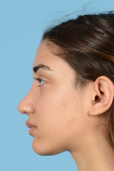 Rhinoplasty Before & After Gallery - Patient 144554654 - Image 10
