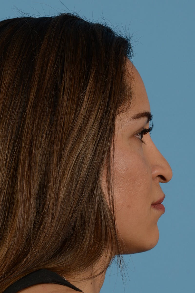 Rhinoplasty Before & After Gallery - Patient 144554667 - Image 5