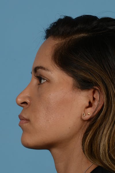 Rhinoplasty Before & After Gallery - Patient 144554667 - Image 10