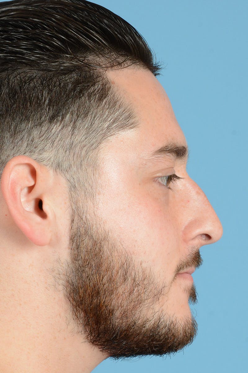 Rhinoplasty Before & After Gallery - Patient 144554646 - Image 5