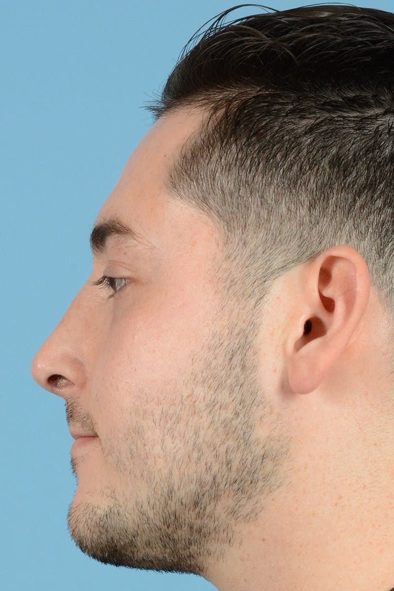 Rhinoplasty Before & After Gallery - Patient 144554646 - Image 10