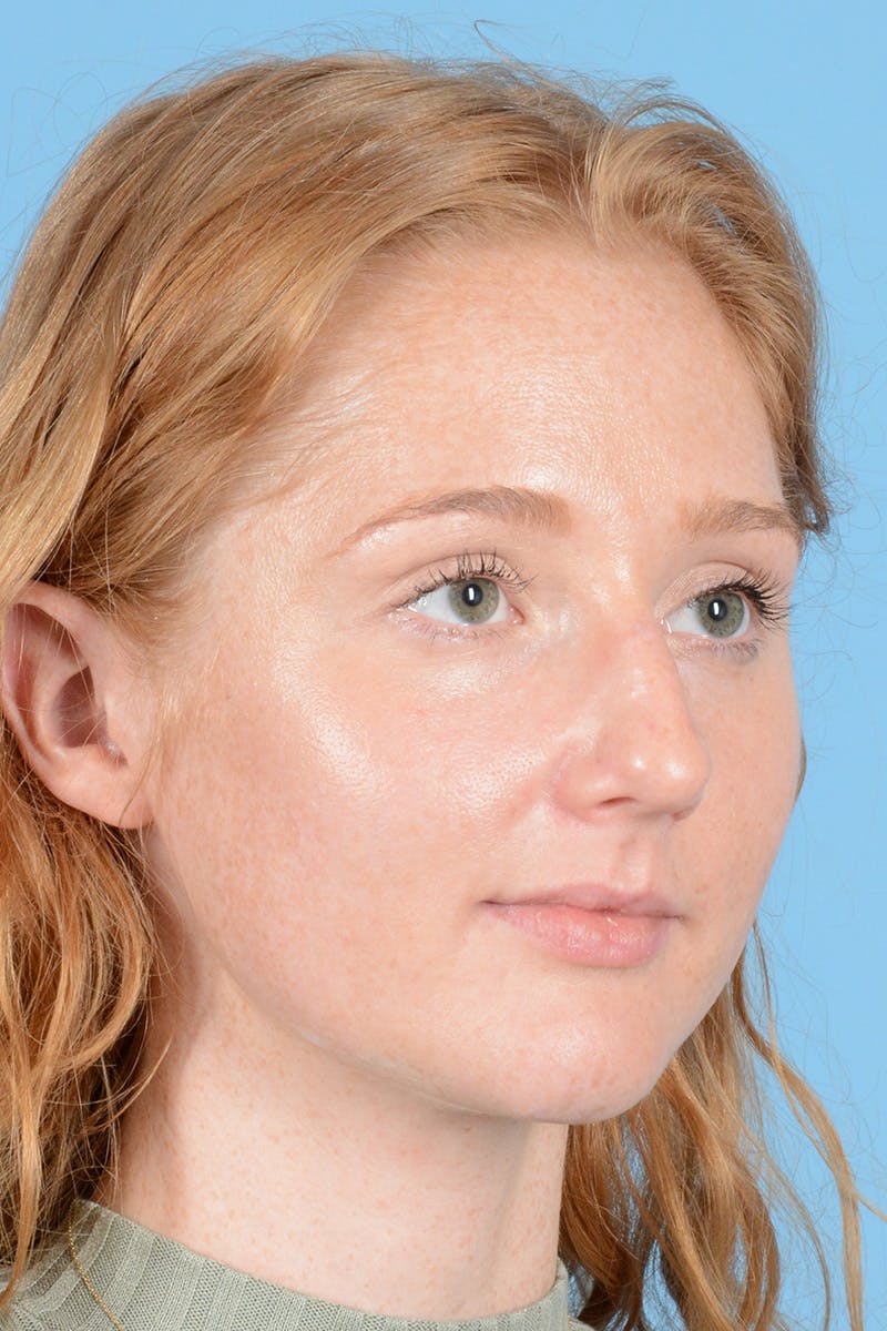 Rhinoplasty Before & After Gallery - Patient 146698158 - Image 3