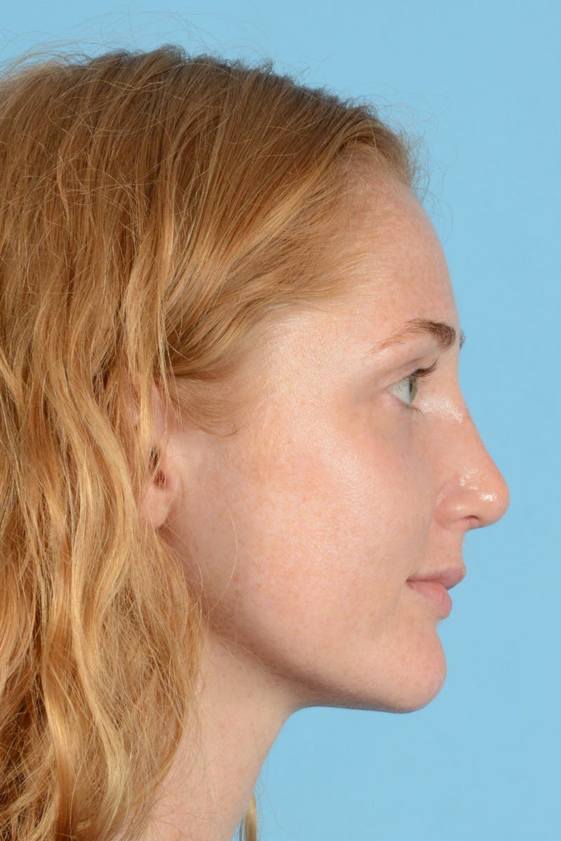 Rhinoplasty Before & After Gallery - Patient 146698158 - Image 6