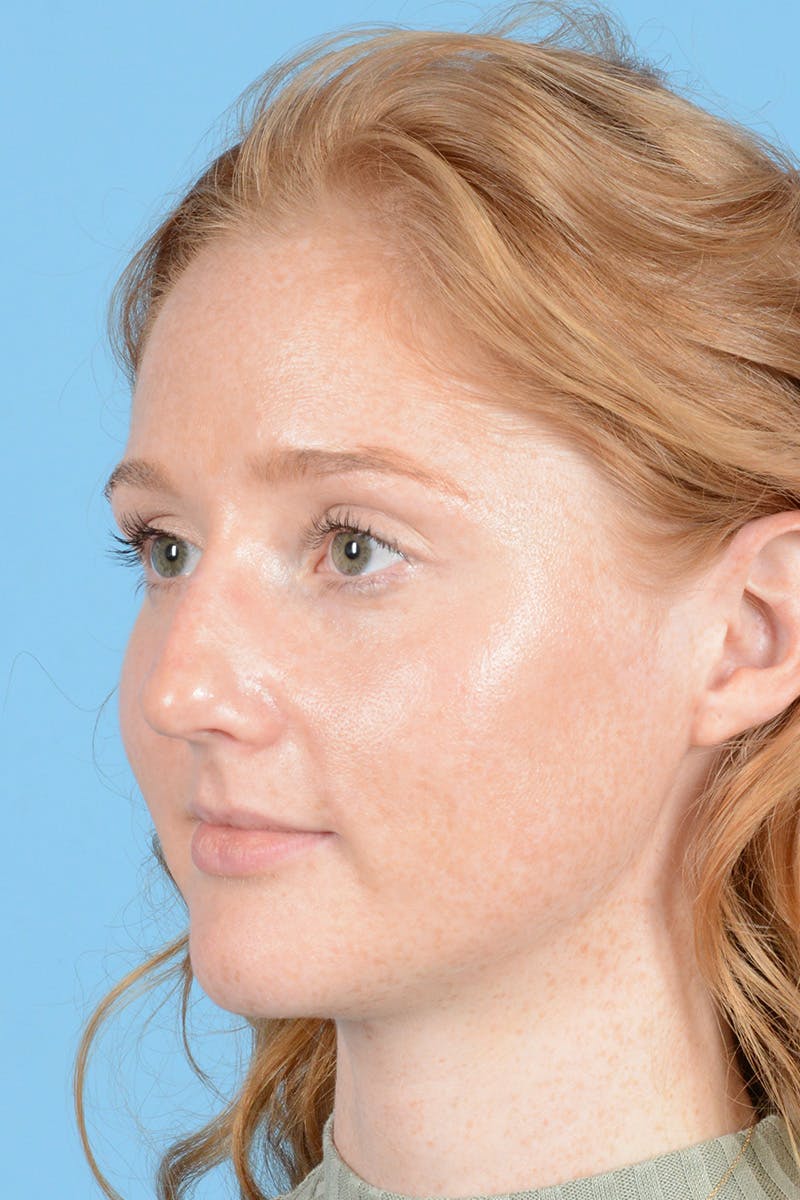 Rhinoplasty Before & After Gallery - Patient 146698158 - Image 7